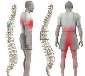 back pain with thoracic osteochondrosis