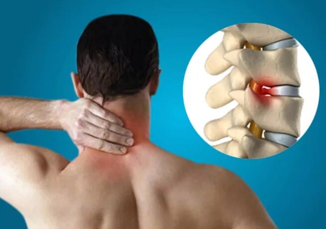 Cervical osteochondrosis