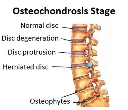 Osteochondrosis stages