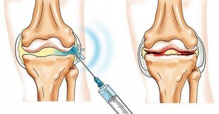 How to treat knee articulation arthrosis