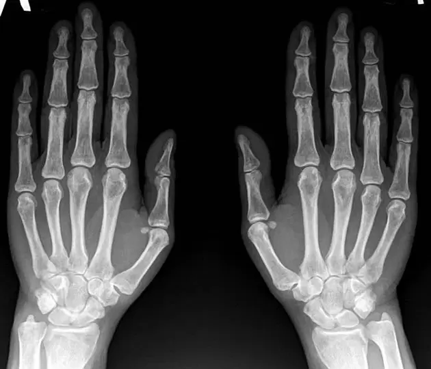 wrist joint arthritis on x-ray before using Hondroine